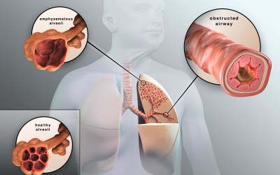 COPD  - “Sát thủ vô hình”