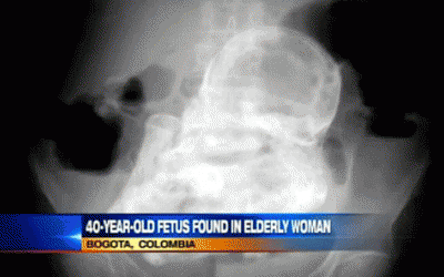 Bào thai 40 tuổi ngoài tử cung cụ bà 82 tuổi