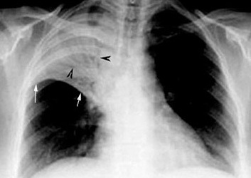 Viêm phổi do... rượu?!