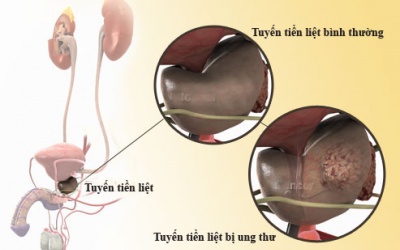 Tiểu ra máu ở người cao tuổi
