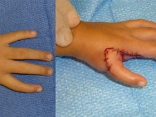 Chỉnh hình bàn tay không ngón cái