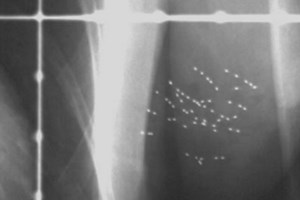 Hạt phóng xạ có thể điều trị tận gốc bệnh ung thư vú