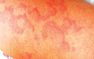 Nhận biết và điều trị mề đay