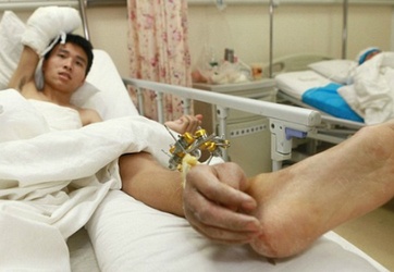 Dùng chân 'nuôi' tay trước khi nối lại