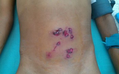 Cứu bé trai bị 10 vết thương do súng tự chế