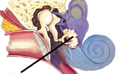 Nguy hiểm từ hội chứng xốp xơ tai