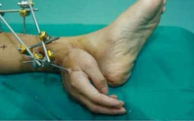 Ghép tay phải vào chân trái để cứu bàn tay