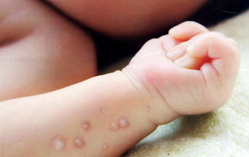 Bệnh tay-chân-miệng: Giảm con số mắc, tăng diện tích lây lan