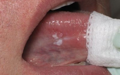 Nhận biết sớm ung thư lưỡi