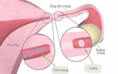 3 dấu hiệu nhận biết nguy cơ tắc vòi trứng ở chị em