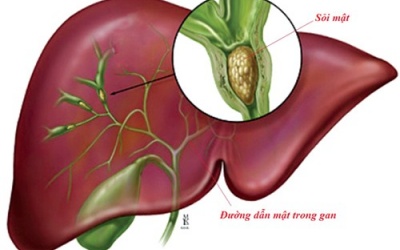 Muốn ngừa sỏi phải lợi mật