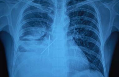 Cứu bệnh nhân nuốt hai cây đinh dài 5cm