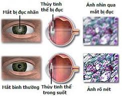 Điều trị đục thủy tinh thể ở người già