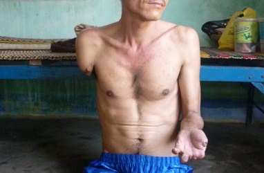 Kinh hoàng người bệnh bất lực nhìn chân tay rụng dần