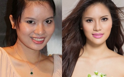 'Gái quê' Lê Thị Phương chia sẻ về 3 lần thẩm mỹ đau đớn