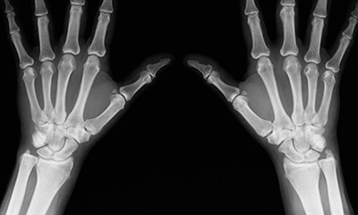 Tái tạo xương từ mỡ hoặc chất béo