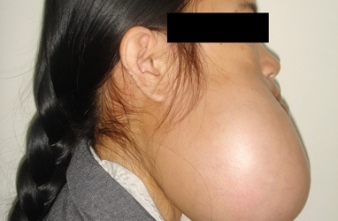 Mất xương hàm do bệnh u men