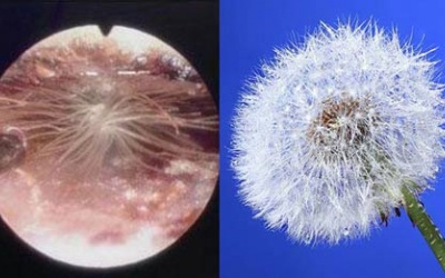 Những đồ vật 'kỳ dị' được lấy ra từ cơ thể người