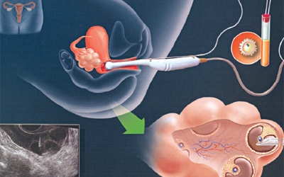Những kỹ thuật trong điều trị vô sinh