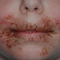 Giấy ướt có thể khiến trẻ bị loét miệng