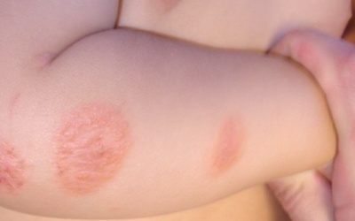 Cách tránh bệnh da mùa lạnh cho em bé