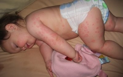 Bệnh sởi quay trở lại: Tăng số ca, trầm trọng biến chứng