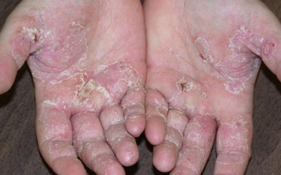 Phân biệt những bệnh về da mùa lạnh