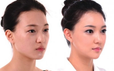 'Hồi xuân' thần tốc nhờ... mỡ trán