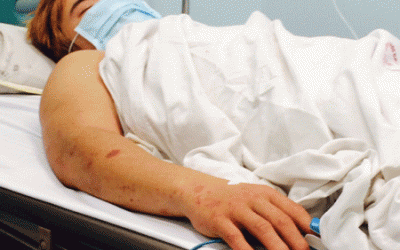 HN: Viêm não mô cầu tái xuất