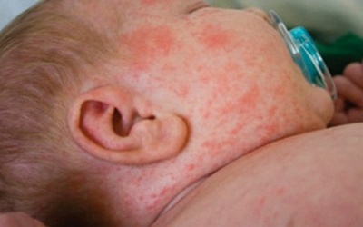 Chặn bệnh sởi từ gia đình