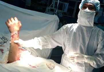 Nối thành công bàn tay bị đứt lìa sau 15 giờ