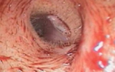 Nữ bệnh nhân bị ấu trùng ruồi giấm khu trú trong tai