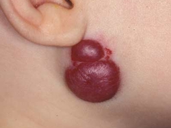 Lượng bệnh nhân điều trị u máu ngày càng tăng