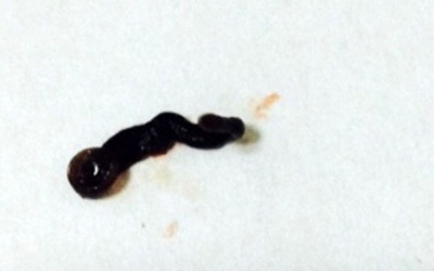 Gắp một con vắt sống dài 4cm trong mắt bệnh nhân