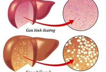 Phòng ngừa tăng mỡ máu ở người cao tuổi