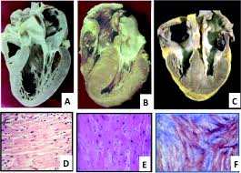 Thế nào là bệnh cơ tim phì đại?