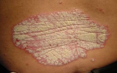 Người bệnh bị ngứa do bệnh vẩy nến