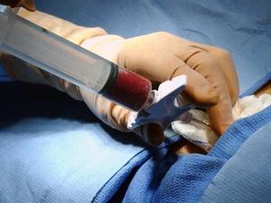 Lần đầu ghép tế bào gốc qua can thiệp mạch