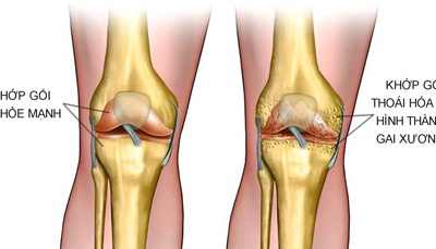 Tế bào gốc mô mỡ tự thân giúp phục hồi sụn khớp