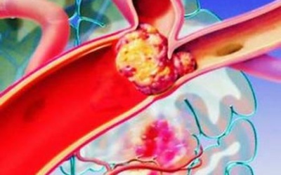 Trẻ đột quỵ vì nhiễm trùng nhẹ