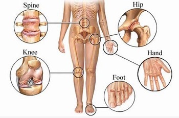 Đối phó bệnh đau nhức xương khớp trong mùa lạnh