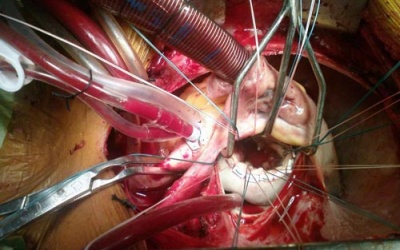 Lần đầu cứu sống trường hợp bị vỡ tim