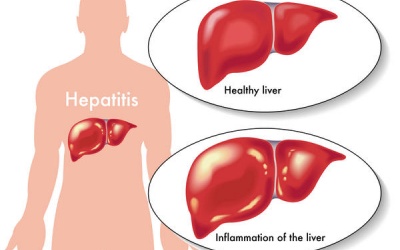 Bệnh viêm gan C có di truyền không?