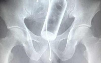 X-quang và nguy cơ ung thư