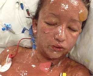 Cô gái phồng rộp toàn thân vì dị ứng thuốc