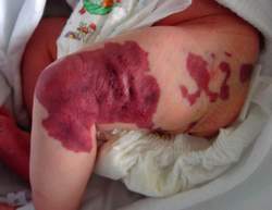 Điều trị thành công cho bé sơ sinh có u máu lớn