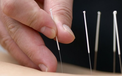 Châm cứu: coi chừng châm xong cấp cứu