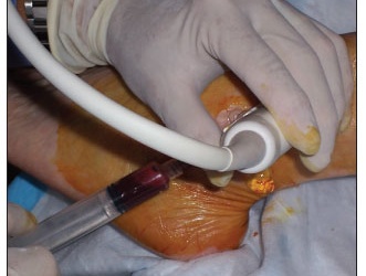 Tiêm huyết tương giàu tiểu cầu trong điều trị thoái hóa khớp gối