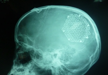 Tái tạo thành công hộp sọ cho bé gái 9 tuổi