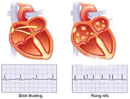 Chất chống đông máu làm giảm nguy cơ đột quỵ ở người rung nhĩ